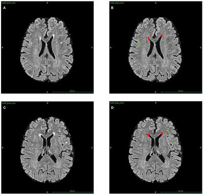 The Correlation Between White Matter Hyperintensity Burden and Regional Brain Volumetry in Patients With Alzheimer's Disease